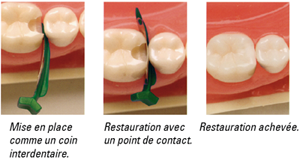 Matrices Fendermate - Directa