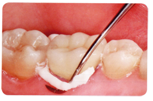 Ketac Cem Plus Automix - 3M ESPE