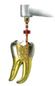 Wave One Gold - Dentsply Maillefer
