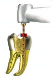 Wave One Gold - Dentsply Maillefer