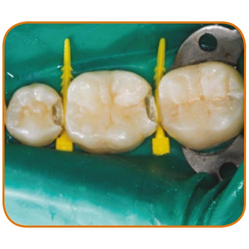 Coins Composi-Tight® 3D Fusion - garrison dental solutions
