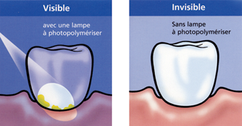 Plaque test - Ivoclar-Vivadent