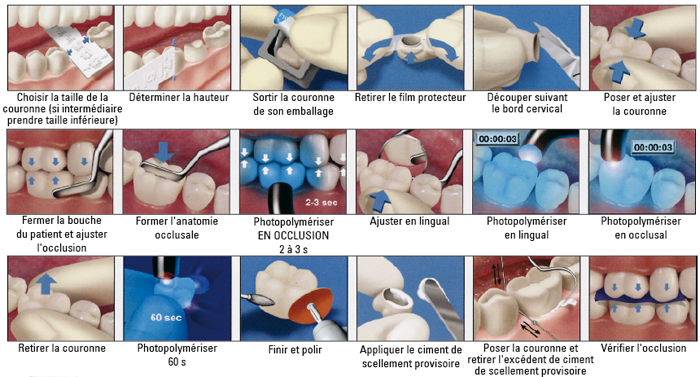 Protemp-Crown - 3M ESPE